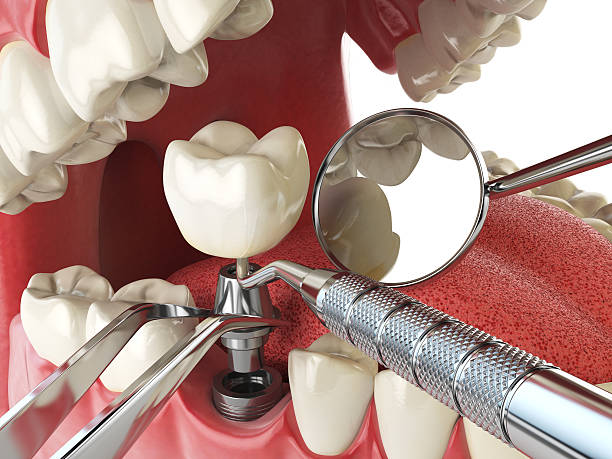 Best Emergency Dental Extractions in St Marys, OH